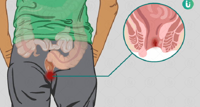 Anal Fissures: Diagnosis & Treatment